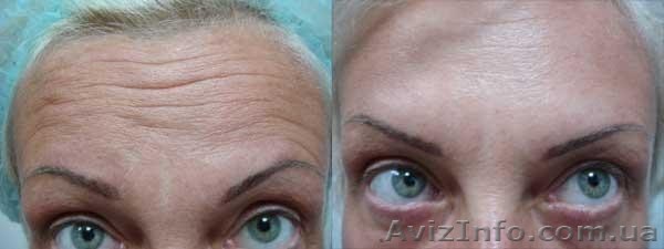 Инъекции Диспорт,ботокс - <ro>Изображение</ro><ru>Изображение</ru> #1, <ru>Объявление</ru> #1205121