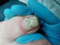 В кабинет закрытого типа приглашаю на медицинский аппаратный педикюр, Харьков - <ro>Изображение</ro><ru>Изображение</ru> #3, <ru>Объявление</ru> #1633708