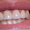 Лечение зубов (кариес,  пародонтоз),  протезирование,  отбеливание (центр Харькова) #92451
