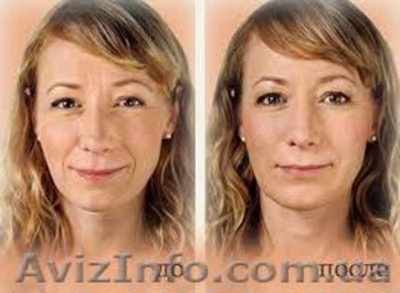 Мезотерапия лица, тела, для волос! Хорошие цены! - <ro>Изображение</ro><ru>Изображение</ru> #3, <ru>Объявление</ru> #936580
