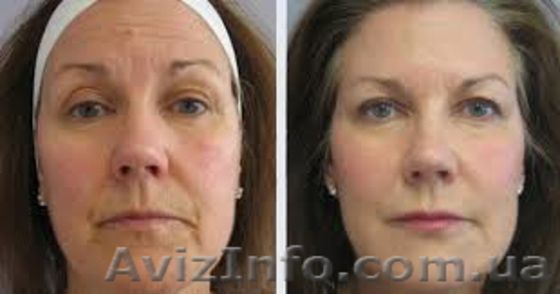  Биоревитализация (омоложение, увлажнение, лифтинг)! - <ro>Изображение</ro><ru>Изображение</ru> #3, <ru>Объявление</ru> #951742