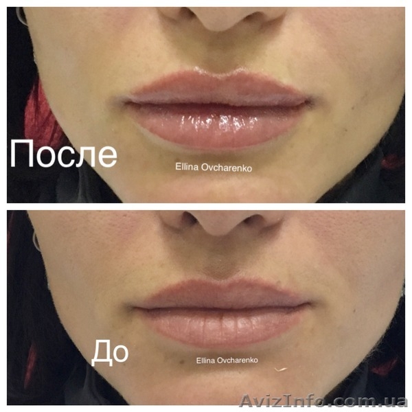 Увеличение губ, скул, заполнение морщин и носогубных складок! - <ro>Изображение</ro><ru>Изображение</ru> #3, <ru>Объявление</ru> #936577