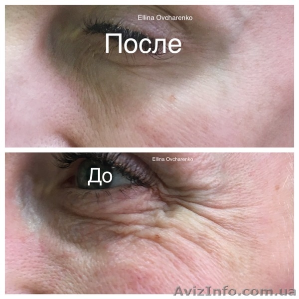 Ботокс.Коррекция мимических морщин - <ro>Изображение</ro><ru>Изображение</ru> #3, <ru>Объявление</ru> #1201963