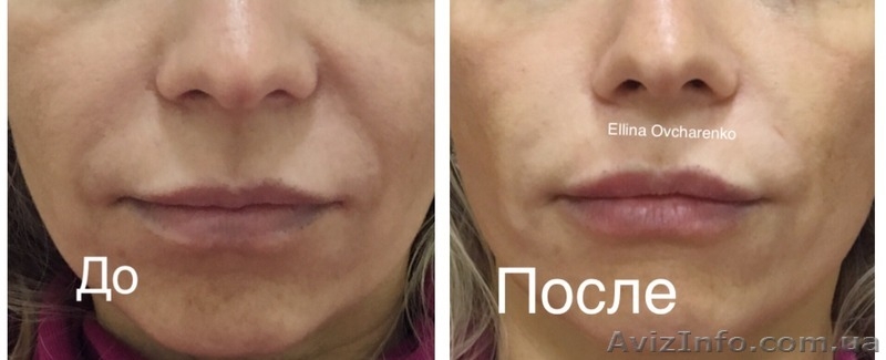 Увеличение губ, скул, заполнение морщин и носогубных складок! - <ro>Изображение</ro><ru>Изображение</ru> #4, <ru>Объявление</ru> #936577