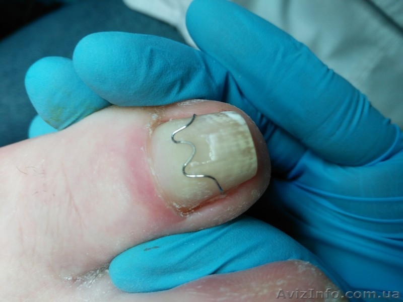 В кабинет закрытого типа приглашаю на медицинский аппаратный педикюр, Харьков - <ro>Изображение</ro><ru>Изображение</ru> #3, <ru>Объявление</ru> #1633708